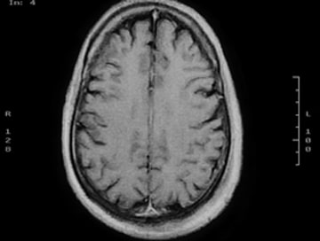 Abogado De Lesiones Cerebrales En Lancaster